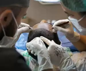 Unshaven Hair Transplant