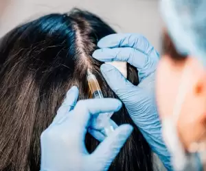 Hair Transplant Women in Turkey