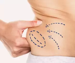 Liposuction in Turkey