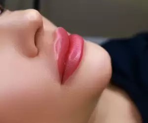 Lip Fillers in Turkey