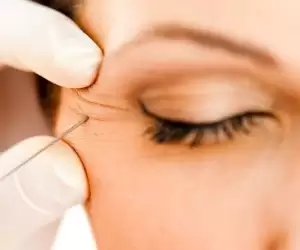 Kaz Ayağı Botox