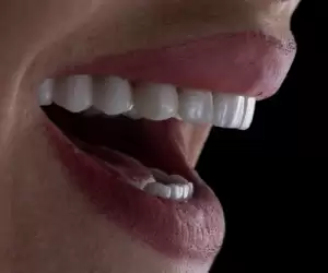 Porcelain Veneers in Turkey