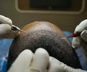 Fue Hair Transplant