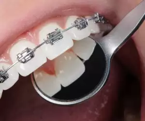 Orthodontics in Turkey